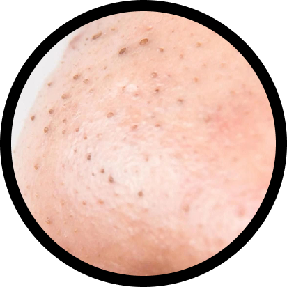 Blackheads